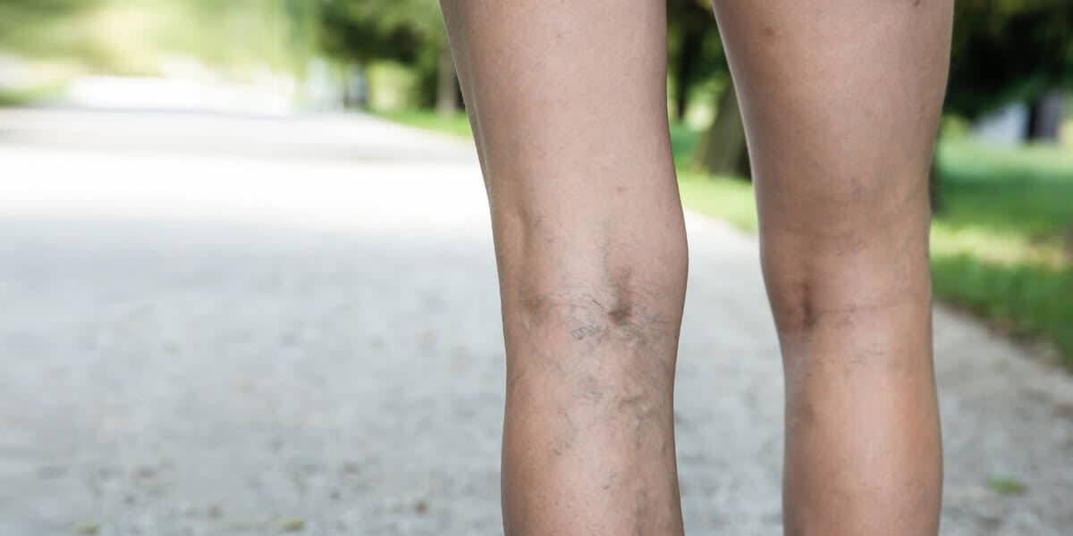 Spider Veins or Venous Disorder?