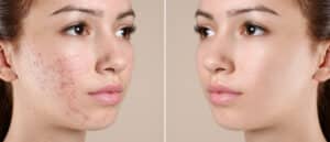 Acne in Adults: Causes, Treatment, and Self-Care Tips | Bellaire Dermatology