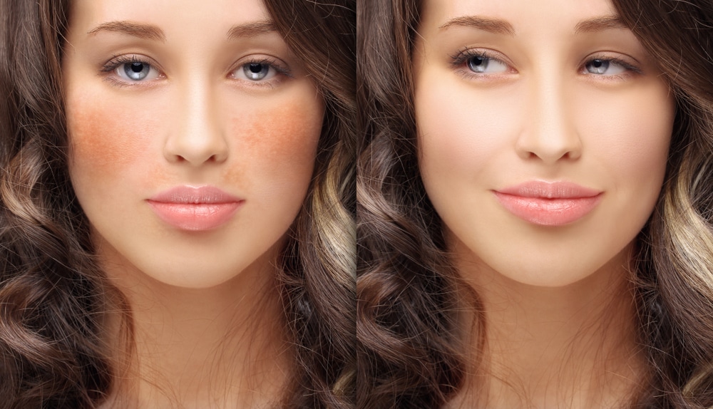 Professional Treatments for Hyperpigmentation: Options and Results | Bellaire Dermatology