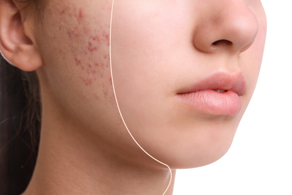 Acne Treatment | Bellaire Dermatology