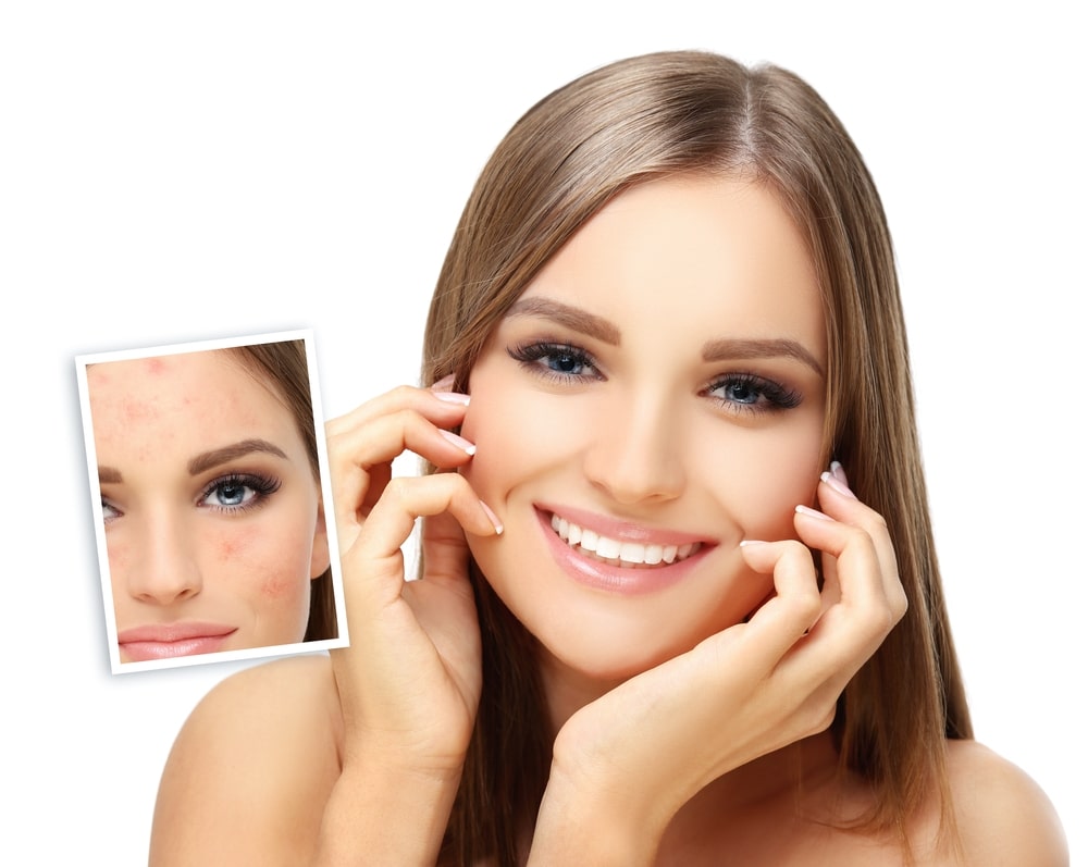 Acne | Bellaire Dermatology