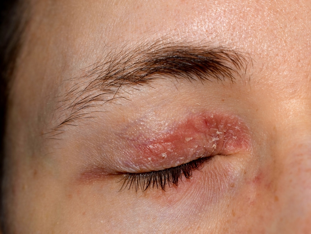 Eczema | Bellaire Dermatology